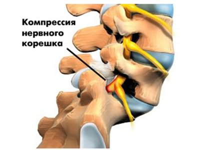 Страничка валеолога за июль 2017 г. Остеохондроз позвоночника