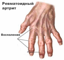 Ревматоїдний артрит